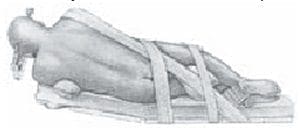 Posición en la mesa quirúrgica.