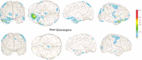 Localización de la fuente MEG Localización de la fuente MEG
