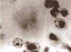 Placa constituida por amiloide Placa constituida por amiloide