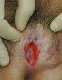 Liquen plano erosivo: placas eritematosas, edematosas, erosionadas en vulva.