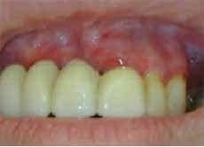 Liquen plano erosivo: compromiso de la mucosa gingival con eritema intenso, edema, mezcladas con vesículas y membranas blanquecinas