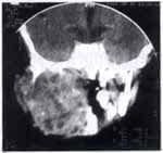 Lesión del conducto auditivo externo