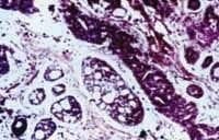 Carcinoma adenoide quístico externo
