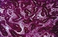 Carcinoma adenoide quístico interno