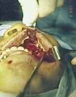 Abordaje por Degloving