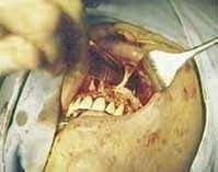 Resección de paredes lateral