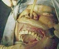 Cierre de abordaje transurcular