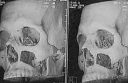 Reconstrucción tridimensional postoperatoria