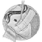 Asa vascular el implante Asa vascular el implante