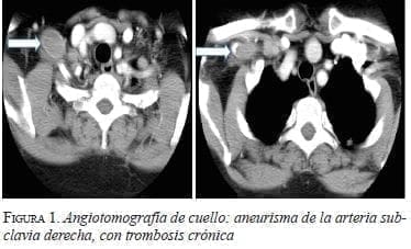 Angiotomografía de Cuello