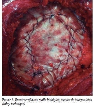 Eventrorrafia con Malla Biológica, Técnica de Interposición 