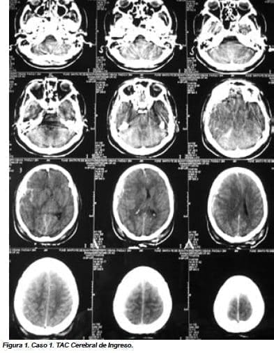 Caso 1. TAC Cerebral de Ingreso