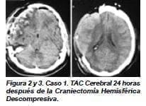 TAC Cerebral 24 horas después de la Craniectomía Hemisférica Descompresiva TAC Cerebral 24 horas después de la Craniectomía Hemisférica Descompresiva