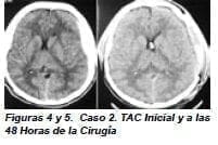 Caso 2. TAC Inicial y a las 48 Horas de la Cirugía Caso 2. TAC Inicial y a las 48 Horas de la Cirugía