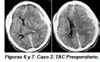 Caso 3. TAC Preoperatorio Caso 3. TAC Preoperatorio