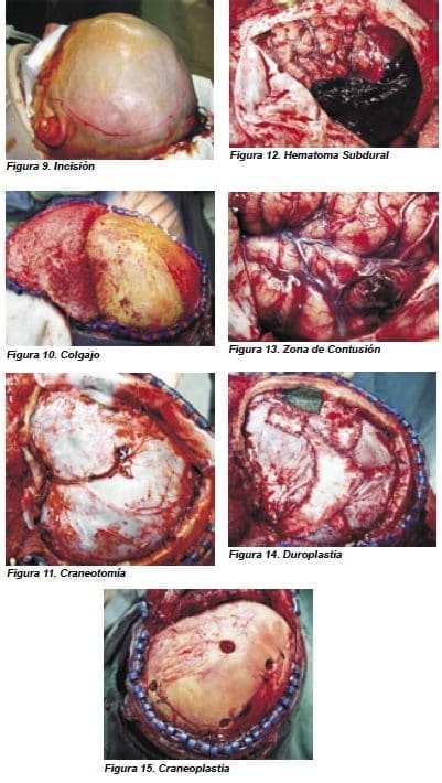 Hematomas Subdurales Agudos