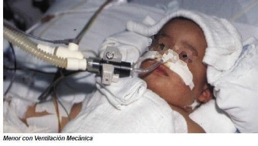 Menor con Ventilación Mecánica