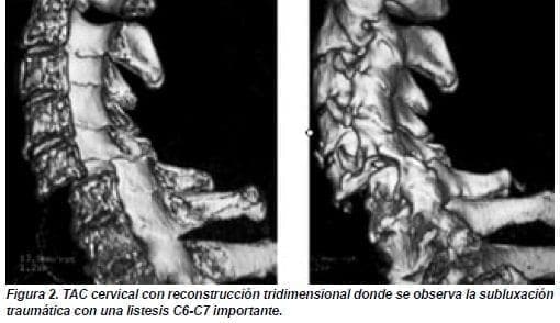 Subluxación Traumática con una Listesis Subluxación Traumática con una Listesis
