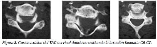 Cortes Axiales del TAC Cervical Cortes Axiales del TAC Cervical