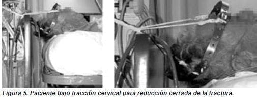 Paciente bajo Tracción Cervical Paciente bajo Tracción Cervical