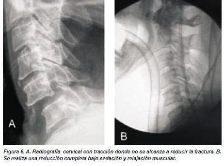 Radiografía Cervical con Tracción donde no se Alcanza a Reducir la Fractura Radiografía Cervical con Tracción donde no se Alcanza a Reducir la Fractura