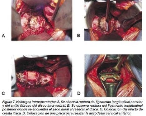 Hallazgos Intraoperatorios Hallazgos Intraoperatorios