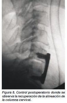 Alineación de la Columna Cervical Alineación de la Columna Cervical