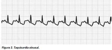 Taquicardia sinusal.