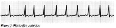 Fibrilación auricular.