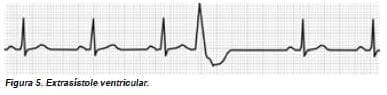 Extrasístole ventricular