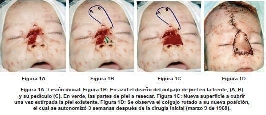 Colgajo Rotado a su Nueva Posición