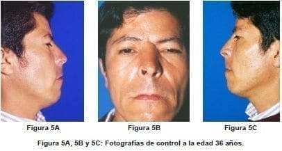 Control a la Edad de 36 Años