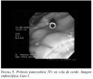 Prótesis Pancreática 7Fr en cola de cerdo