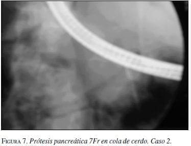 Prótesis Pancreática 7Fr en cola de cerdo. Caso 2.