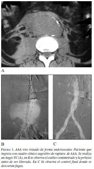 AAA Roto Tratado de forma Endovascular AAA Roto Tratado de forma Endovascular