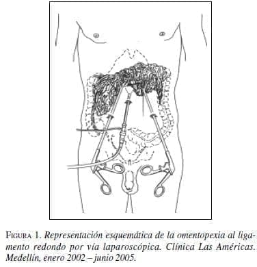 Omentopexia al Ligamento Redondo por Vía Laparoscópica