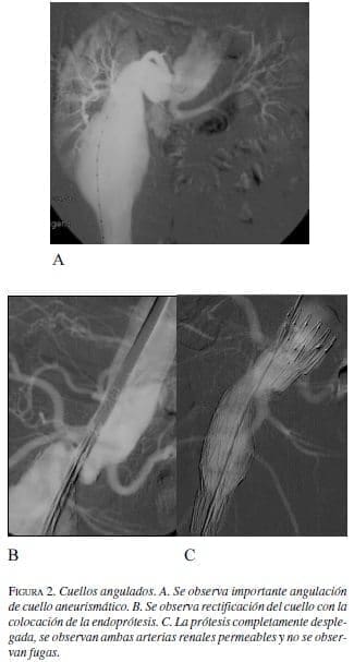 Cuellos Angulados Cuellos Angulados