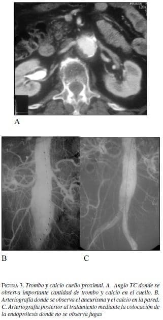Trombo y Calcio Cuello Proximal Trombo y Calcio Cuello Proximal