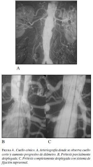 Cuello Cónico Cuello Cónico
