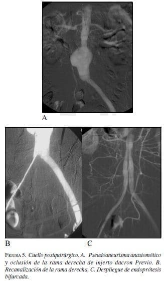 Cuello Postquirúrgico Cuello Postquirúrgico