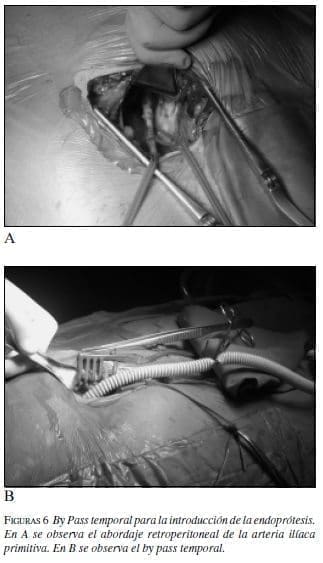 Introducción de la Endoprótesis