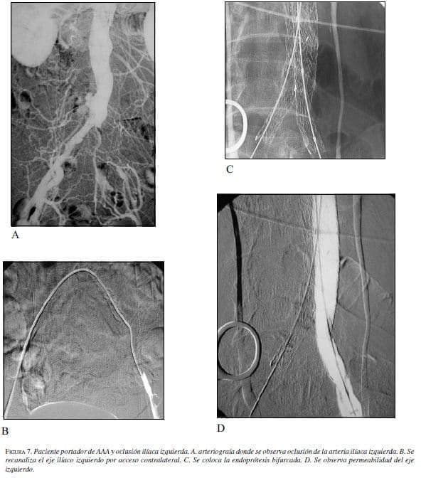 Paciente portador de AAA y Oclusión Ilíaca Izquierda