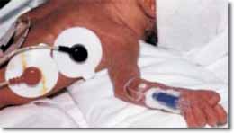 PICC en un Recién Nacido Pretérmino. PICC en un Recién Nacido Pretérmino.