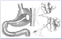 Gastrostomía con Avance a Yeyuno Gastrostomía con Avance a Yeyuno