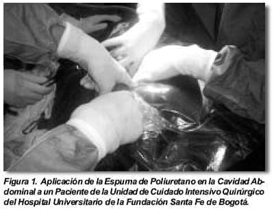 Aplicación de la Espuma de Poliuretano en la Cavidad Abdominal