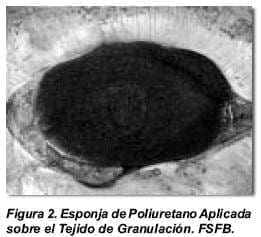 Esponja de Polieuretano en la Cavidad Abdominal Esponja de Polieuretano en la Cavidad Abdominal