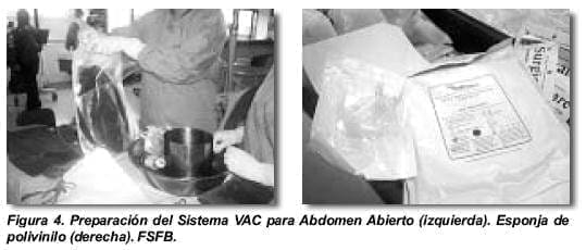 Preparación Sistema VAC para Abdomen Abierto Preparación Sistema VAC para Abdomen Abierto
