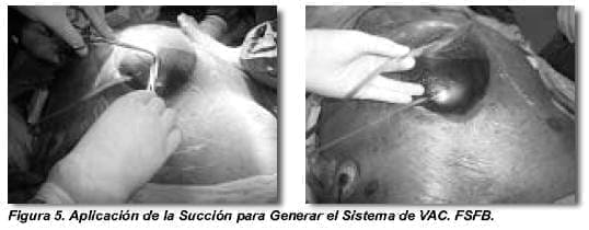 Aplicación de la Succión para Generar el Sistema de VAC Aplicación de la Succión para Generar el Sistema de VAC