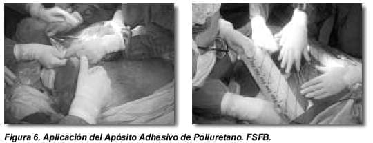 Aplicación del Apósito Adhesivo de Poliurtetano Aplicación del Apósito Adhesivo de Poliurtetano