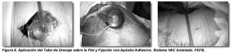 Aplicación del Tubo de Drenaje sobre la Piel y Fijación con Apósito Aplicación del Tubo de Drenaje sobre la Piel y Fijación con Apósito